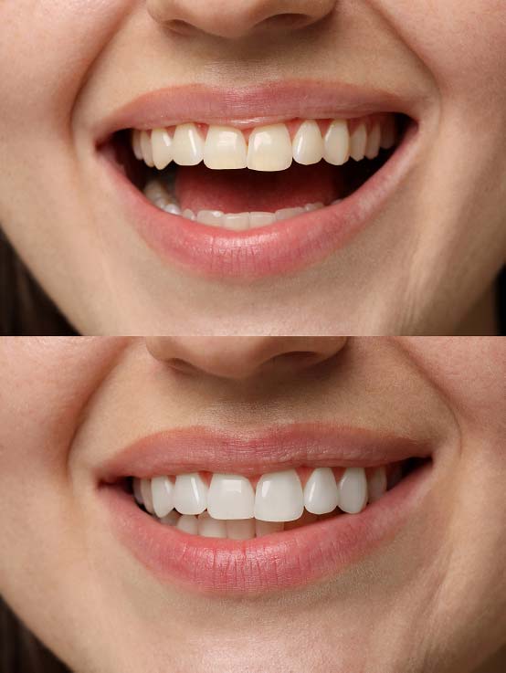 Advanced Dental Whitening